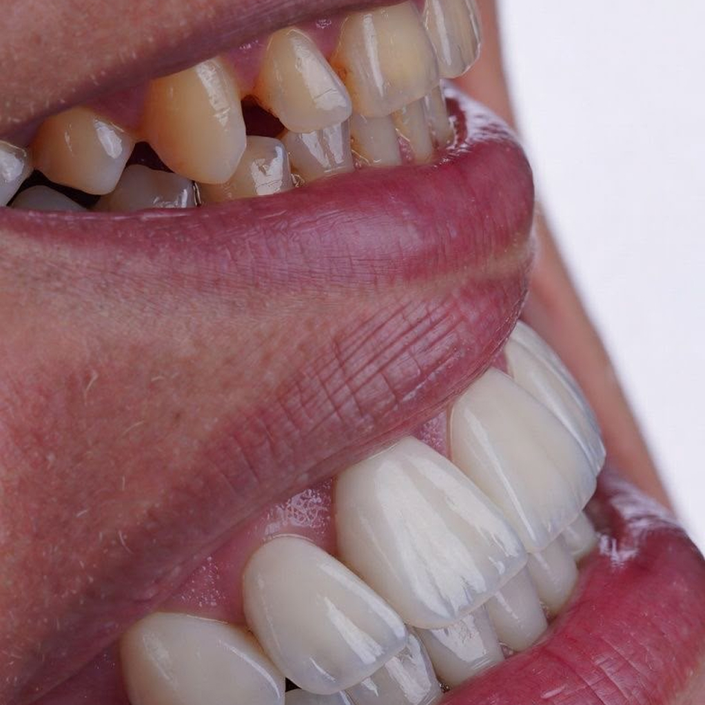 Transformação sorriso Caso 01 — BCX Odontologia