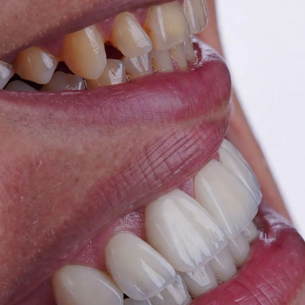 Antes e depois de reabilitação oral e tratamento de bruxismo Caso 01 - BCX Odontologia